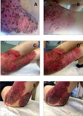 Case Report: Prolonged clinical benefit with sequential trastuzumab-containing treatments in a patient with advanced extramammary Paget disease of the groin